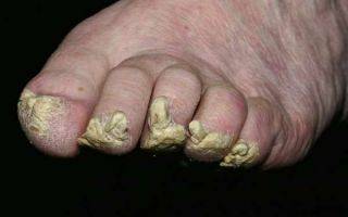Желтые ногти на руках: причины, диагностика, лечение
