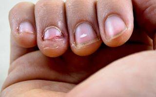 Привычка грызть ногти: причины для взрослых