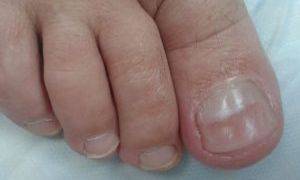 Онихорексис или расщепление ногтей: причины, лечение и фото