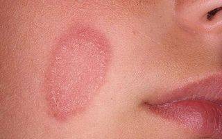 Что делать, если аллергия на коже, красные пятна в виде точек чешутся, лечение?