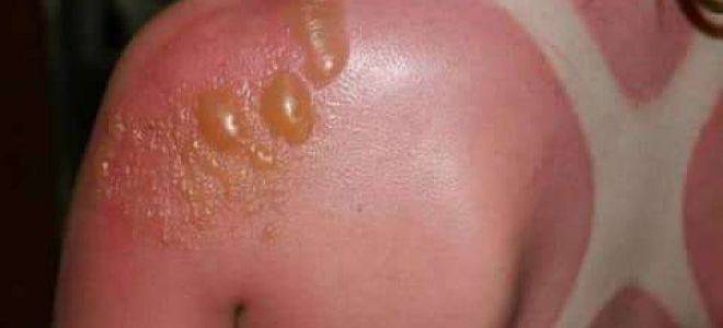 Образование пузырей на коже в следствии заражения буллезным дерматитом