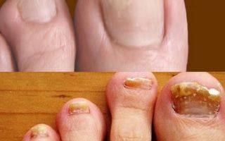 Основные причины появления грибка ногтей на ногах