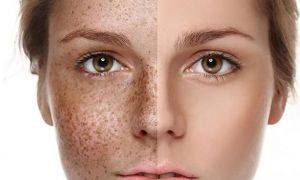 Как и чем можно отбелить в домашних условиях кожу лица?