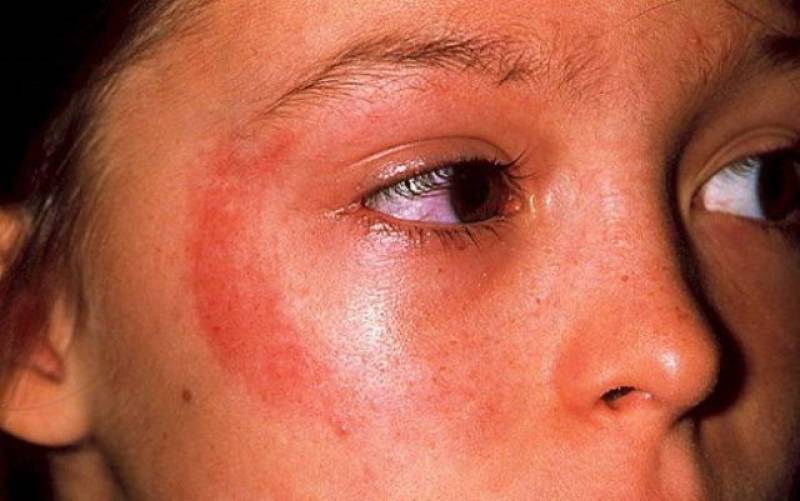 Солнечный дерматит лечение мази — аллергия