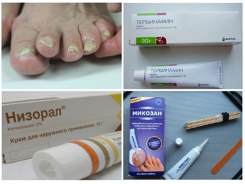 Обзор лекарств от грибка ногтей на ногах — список самых эффективных препаратов