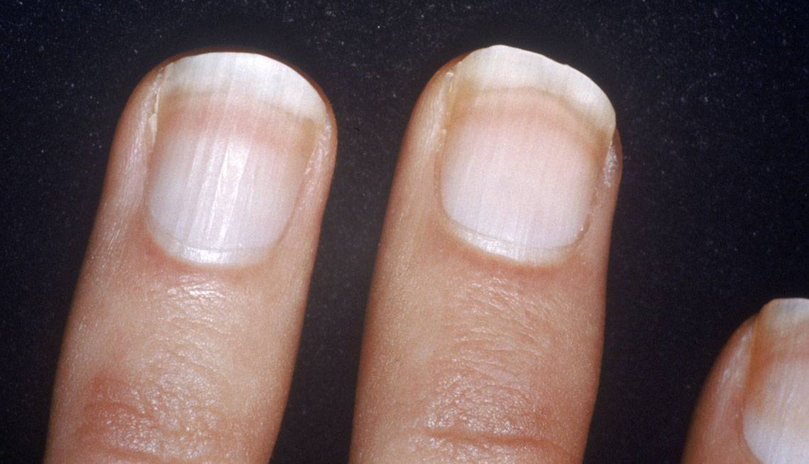 Почему появляются продольные полосы на ногтях