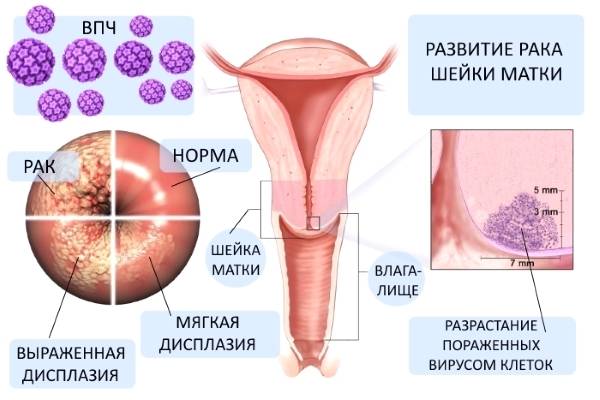 Опасен ли вирус папилломы человека у женщин в гинекологии