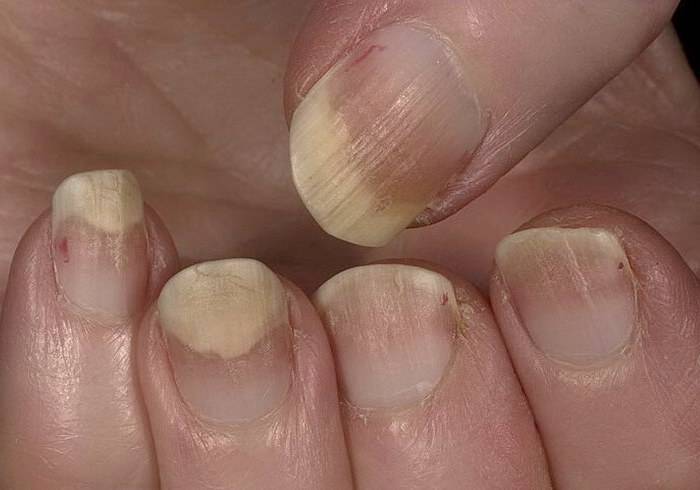 Псориаз ногтей — лечение хронической кожной патологии