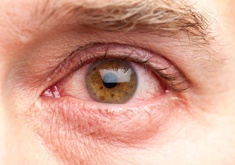 Псориаз на глазах и веках: стадии, симптомы, причины и лечение