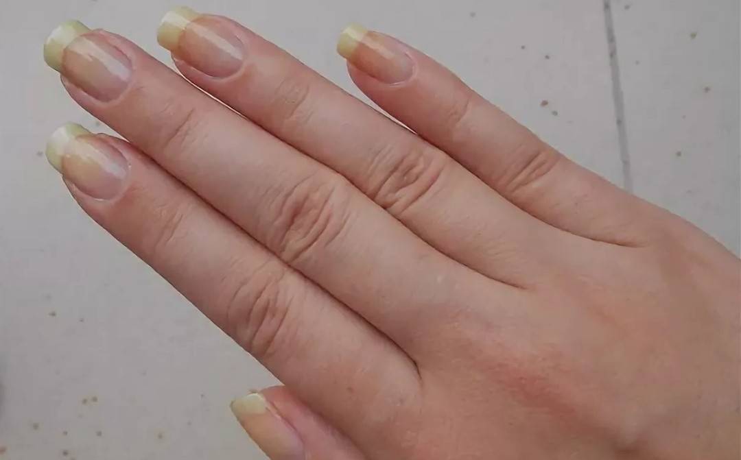 Желтые ногти на руках и ногах: причины и лечение