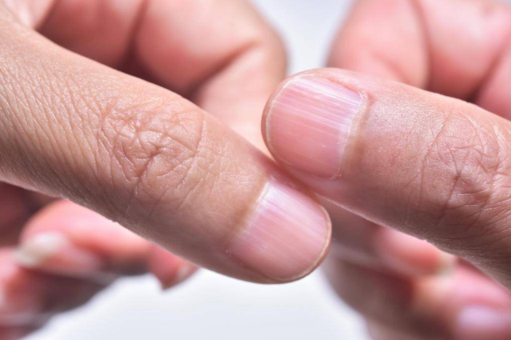 11 причин появления черных полос на ногтях