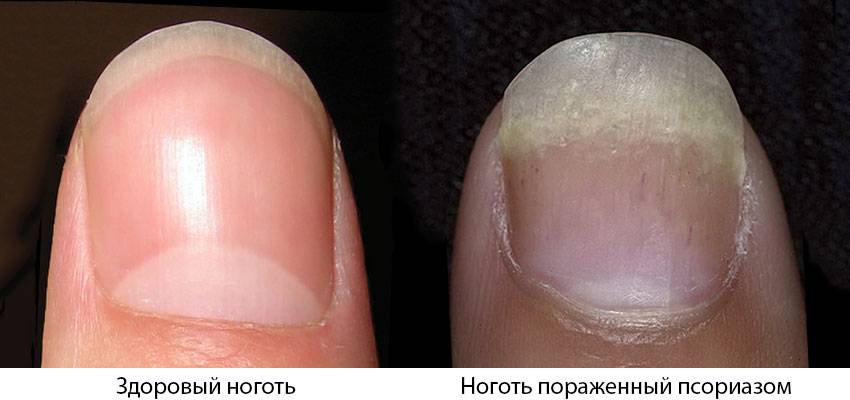 Болезни ногтей на руках: фото и описание, причины возникновения и симптомы заболеваний, принципы их лечения и профилактики