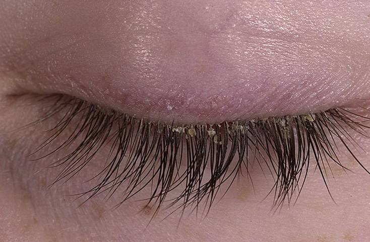 Псориаз на глазах - причины, симптомы и лечение