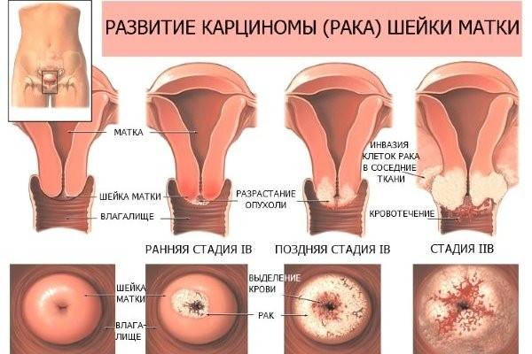 Папиллома шейки матки (фото)