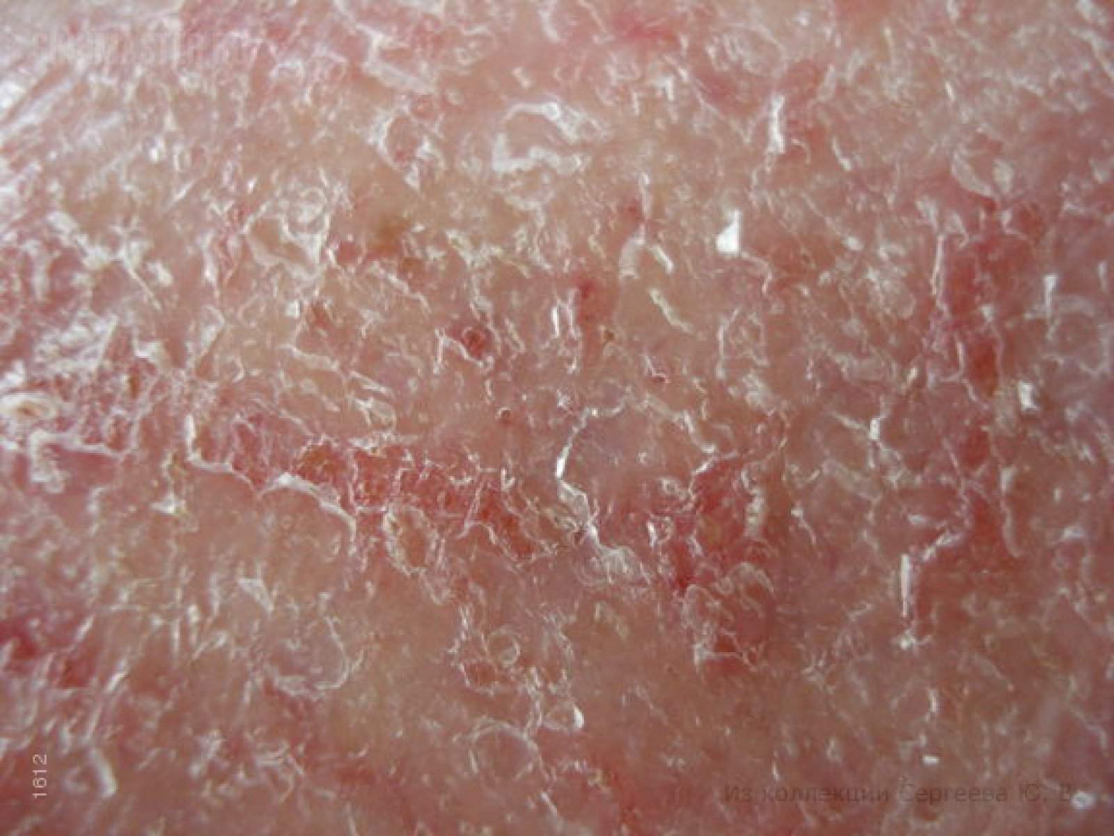 Гиперкератотическая экзема лечение - лечим кожу
