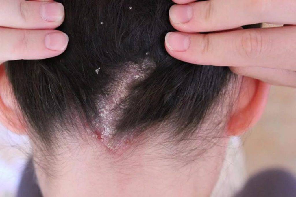 20 заболеваний кожи головы: симптомы болезни и лечение волосяного покрова и волосистой части - причины