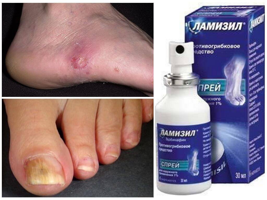Эффективные средства от грибка ногтей на ногах – препараты для лечения, отзывы