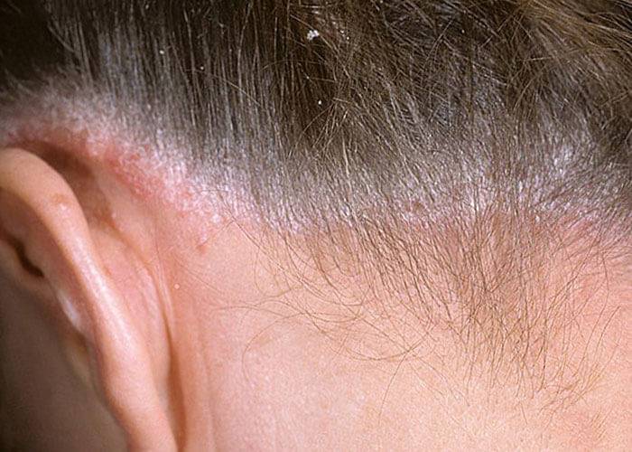 Псориаз волосистой части головы: лечение и фото на голове больных