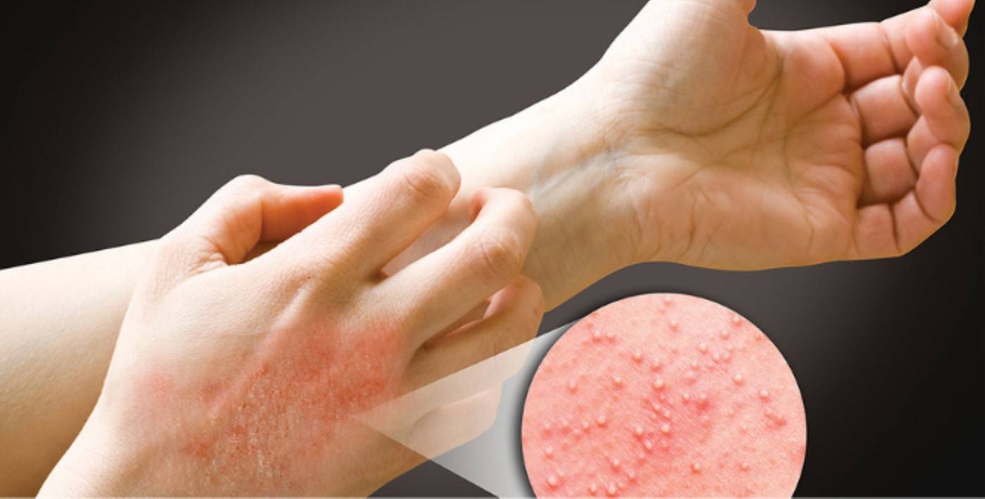 Что такое дерматит, лечение, эффективные аптечные мази и кремы, 5 средств народной медицины для восстановления и очищения кожи
