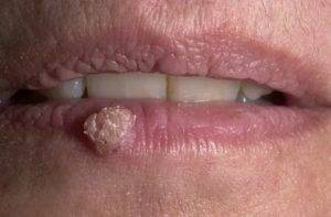 Папилломы и кондиломы на половых губах: чем опасны, их причины, симптомы, диагностика, методы лечения и удаления у женщин