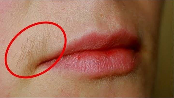 Как избавиться от усиков у женщин над верхней губой навсегда: 6 способов эпиляции усов в домашних условиях | qulady