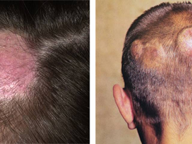 Стригущий лишай на голове: диагностика, лечение микроспории волосистой части головы человека, фото