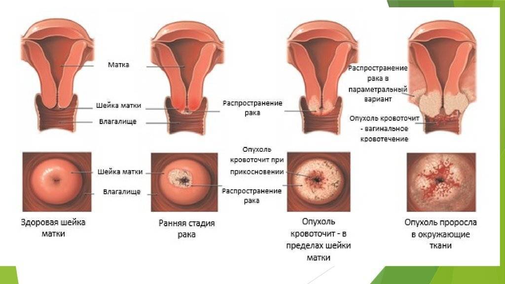 Папиллома на шейке матки: причины возникновения, лечение