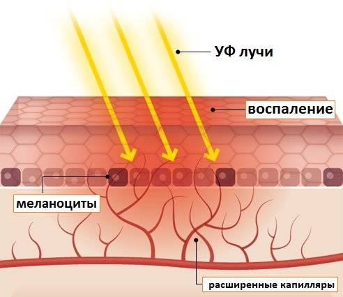 Аллергия на солнце: пятна на коже и не только