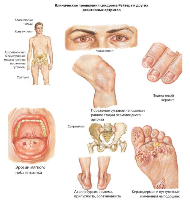 Псориатический артрит - симптомы и проявление. лечение и диета при псориатическом артрите суставов