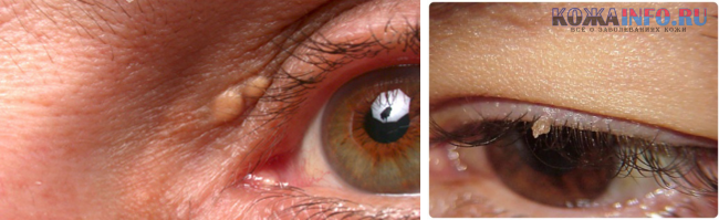 Папиллома на глазу — причины, симптомы и лечение, способы удаления