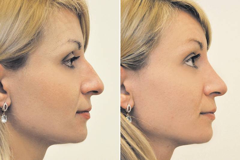 Ринопластика носа в москве, цены, пластика кончика носа до и после, операция ринопластики