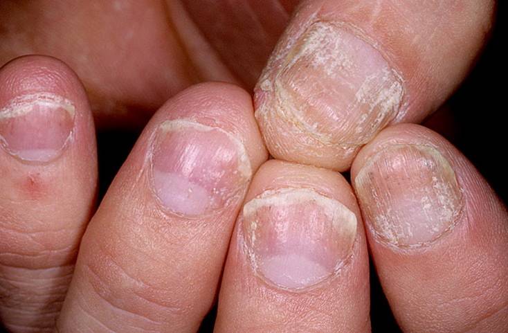 Псориаз ногтей: лечение, фото на руках и ногах, отзывы