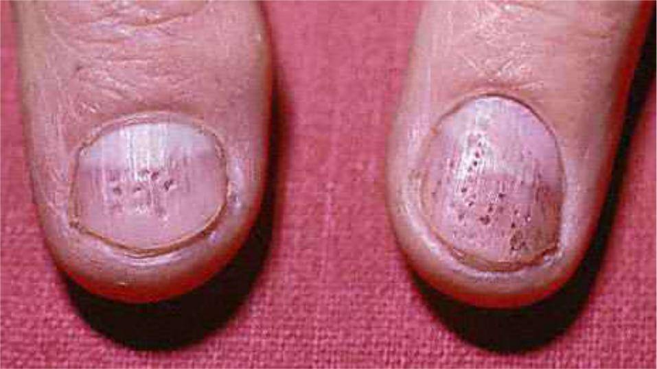 Причины и лечение псориаза ногтей на ногах и руках