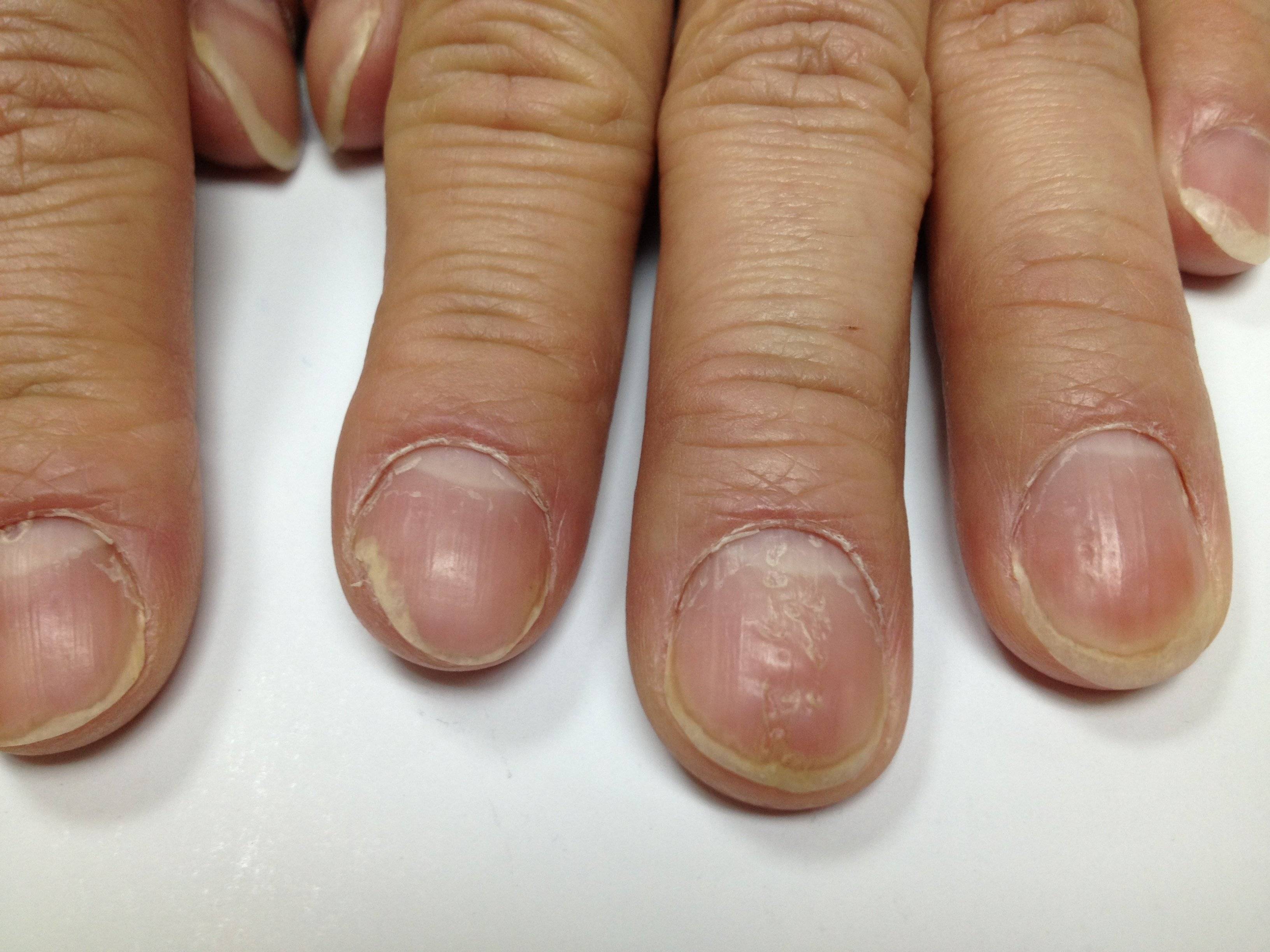 Псориаз ногтей: фото и видео болезни, лечение и профилактика заболевания