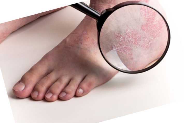 Фото и симптомы псориаза кожи: признаки как начинается псориаз, начальная и первая стадия