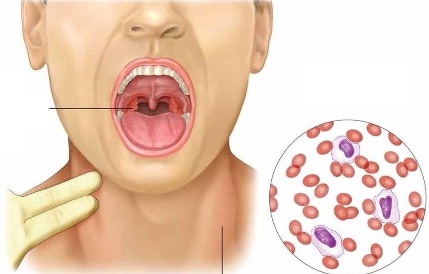 Папиллома в горле: места появления, методы удаления и лечение