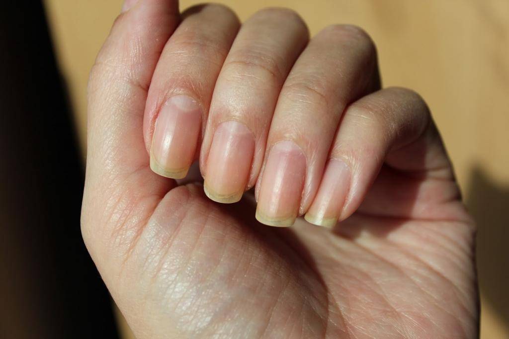 Желтые ногти на руках, причины появления, методы устранения, отбеливание ногтей в домашних условиях