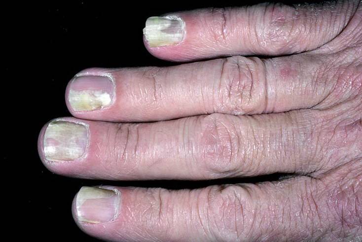 Псориаз ногтей: фото, лечение