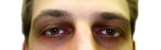 Причины появления у мужчин тёмных кругов под глазами и методы их устранения