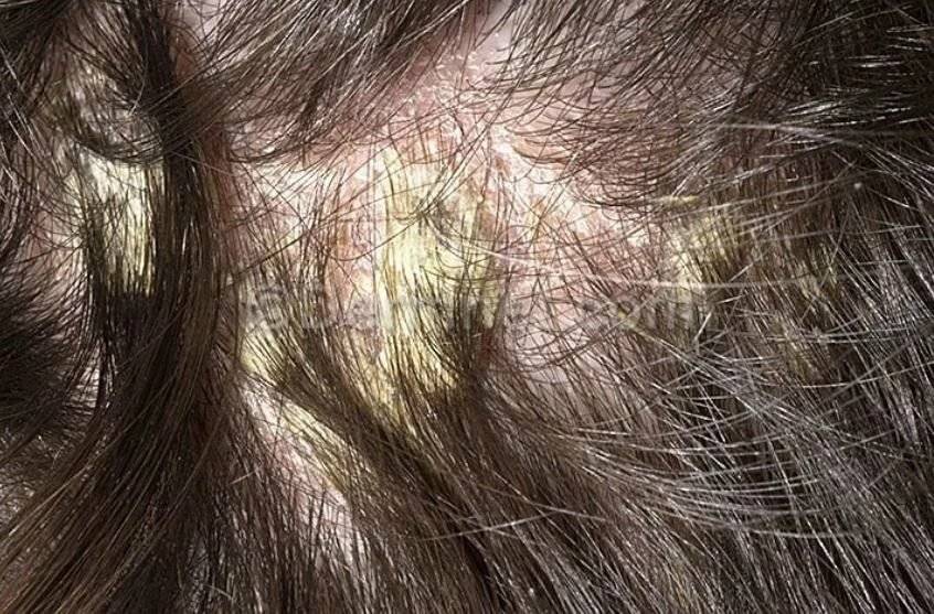 Эффективные средства от псориаза волосистой части головы