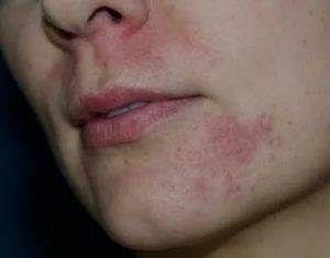 Периоральный дерматит (пероральный): причины и лечение стероидного дерматита на лице