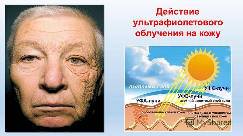 Аллергия на солнце: фото, симптомы, лечение. чем лечить аллергию на солнце