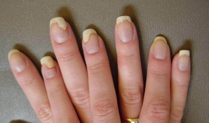Псориаз ногтей, общая симптоматика и разновидности