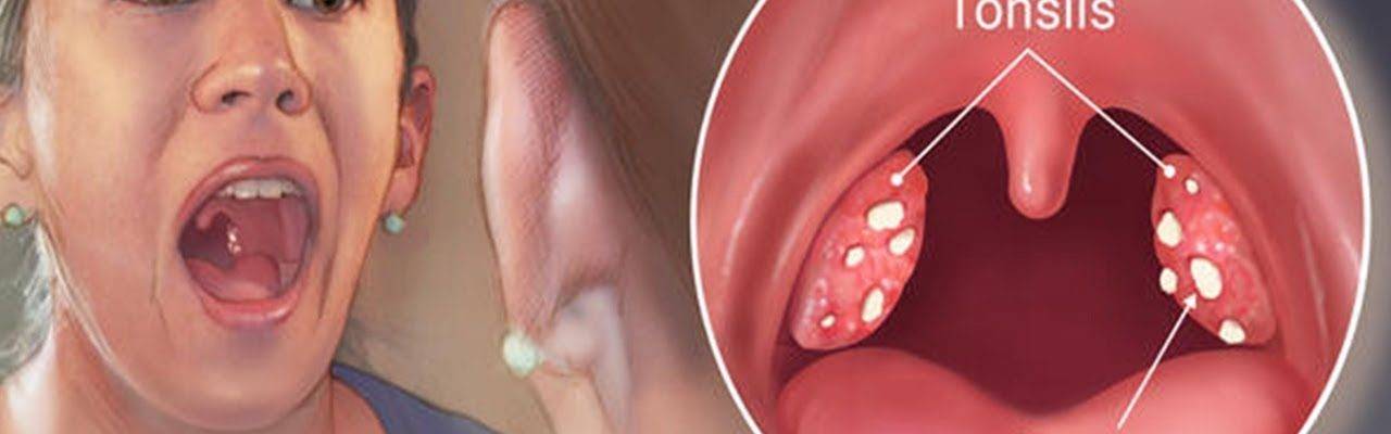 Причины и симптомы папилломатоза в горле. чем опасен? какие методы удаления?