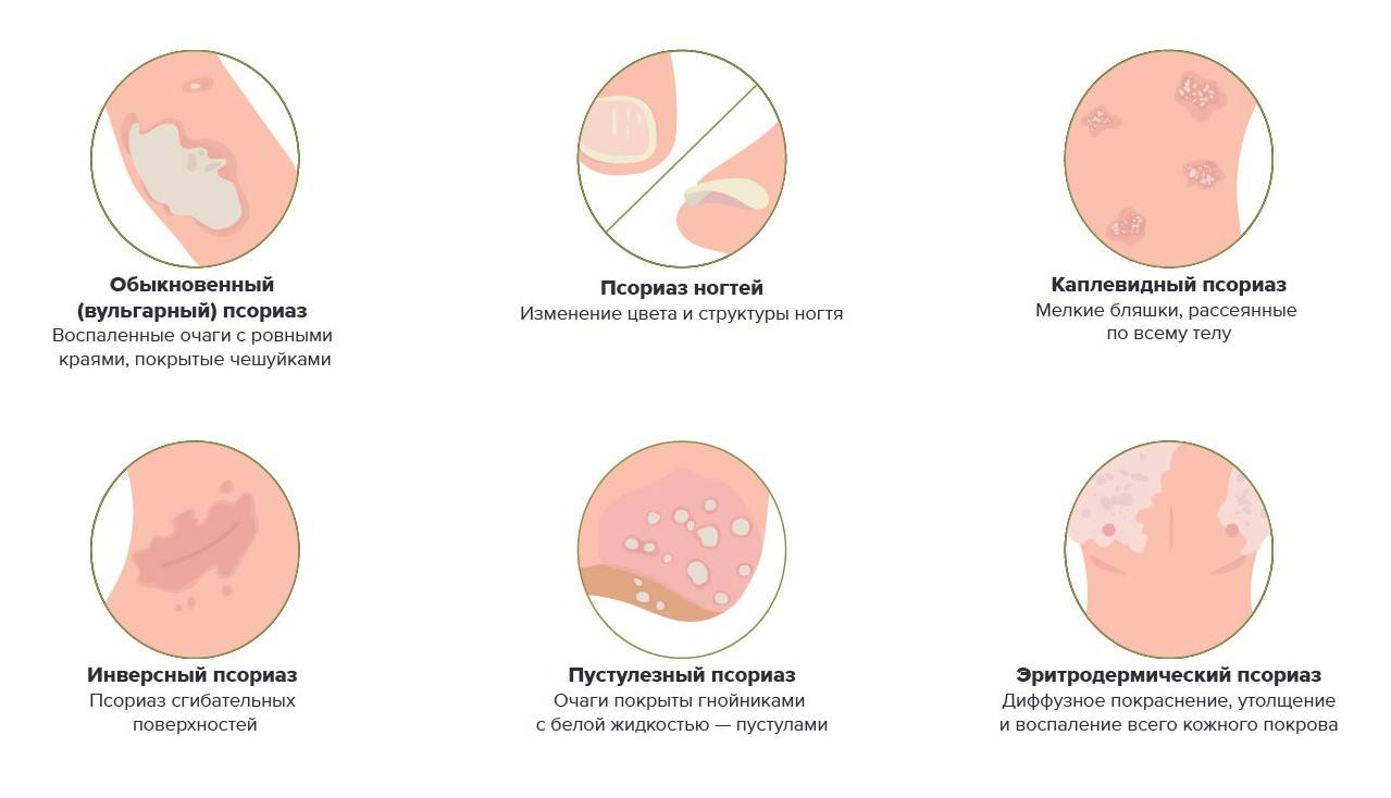 Псориаз — симптомы и признаки: как проявляются феномен кебнера, псориатическая триада и бляшки