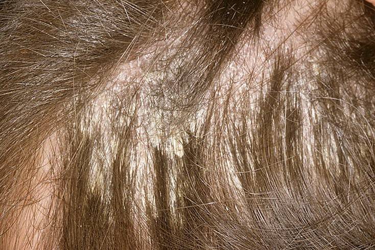 Как выглядит псориаз волосистой части головы и как его лечить?