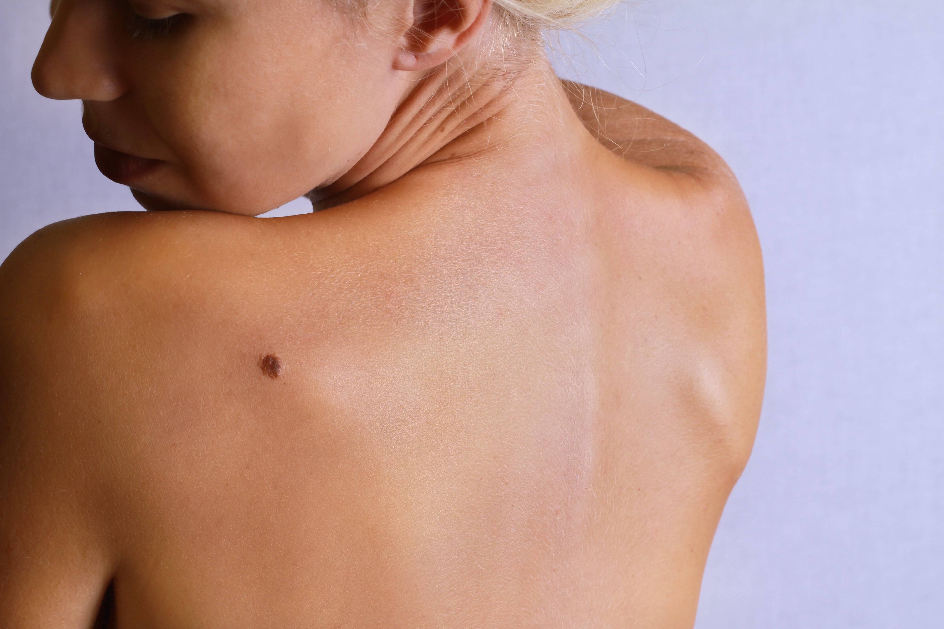 Папилломы на спине: лечение, причины, фото