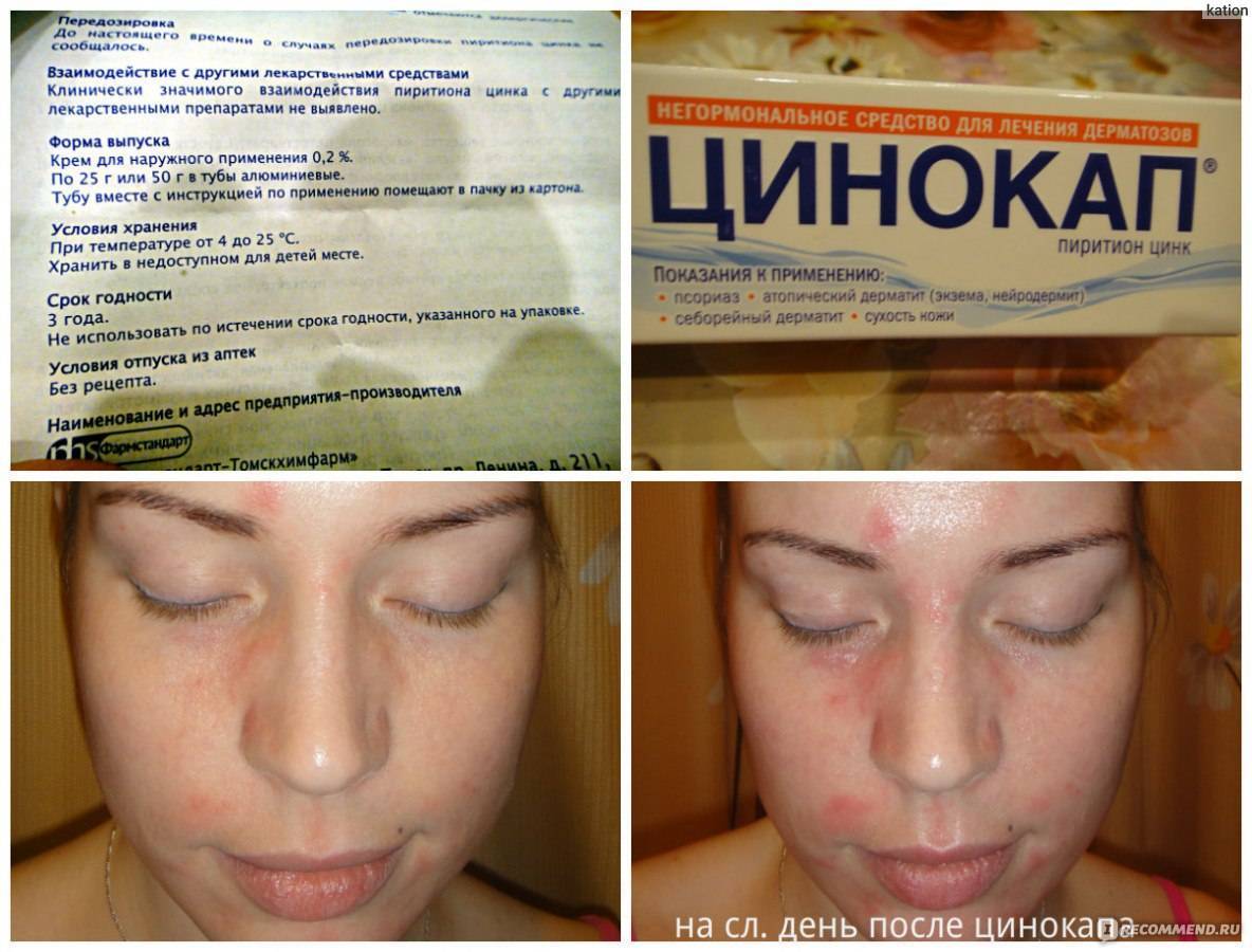 Себорейный дерматит кожи головы: лечение и фото