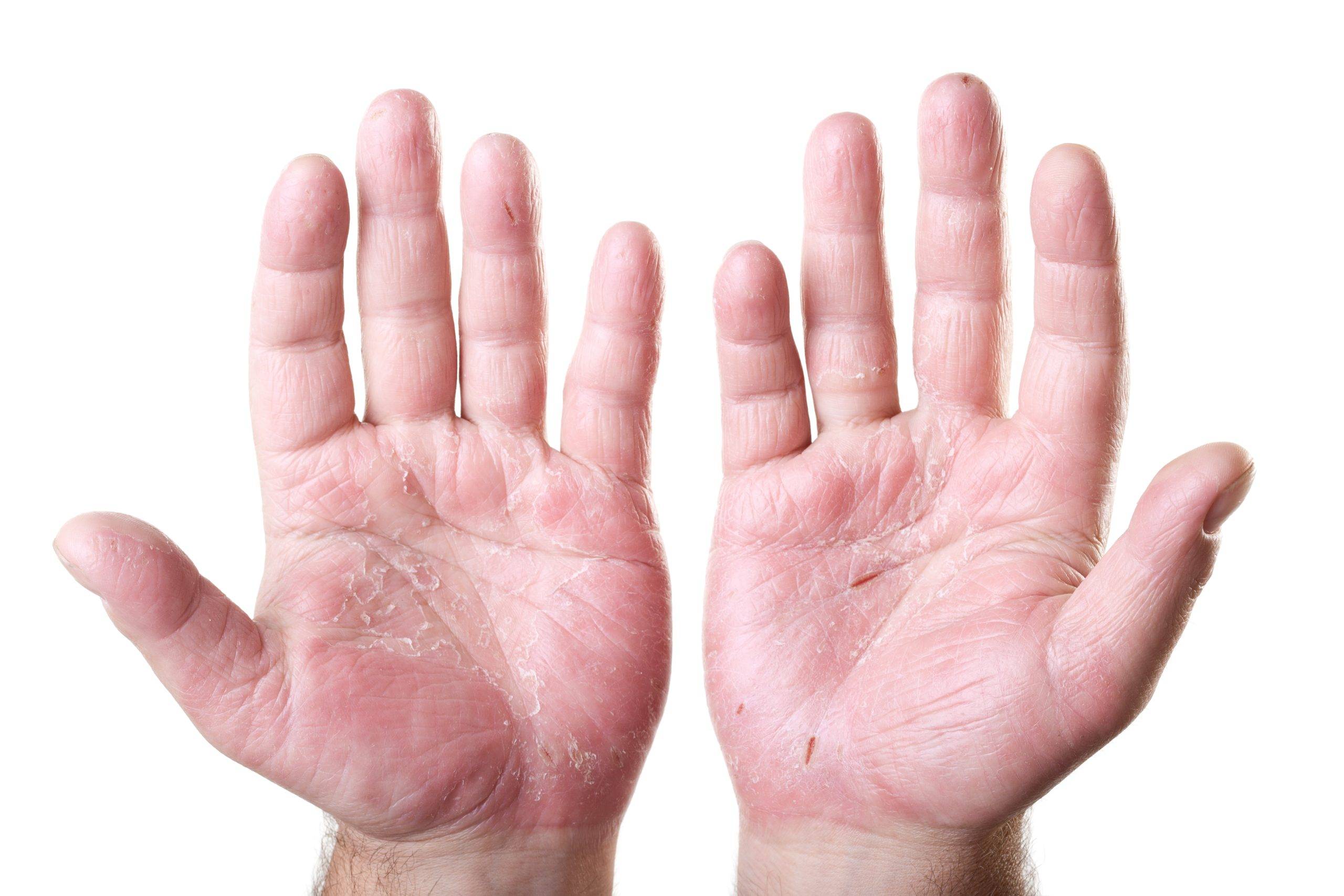 Псориаз на пальцах рук: фото, причины, симптомы и лечение : labuda.blog
псориаз на пальцах рук: фото, причины, симптомы и лечение — «лабуда» информационно-развлекательный интернет журнал