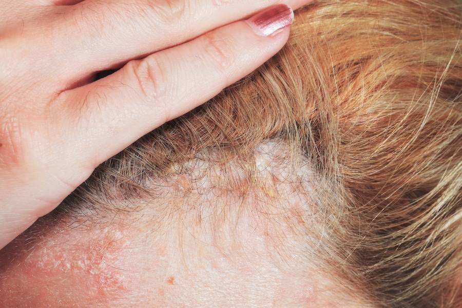 Псориаз на голове : причины, симптомы, диагностика, лечение | компетентно о здоровье на ilive